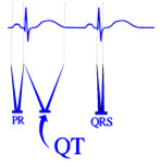 QT-interval-small.jpg